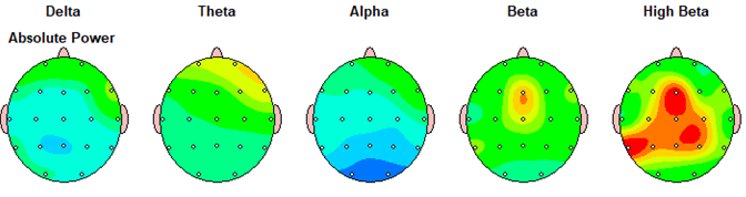 Developmental Trauma QEEG